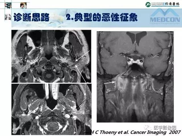 腮腺肿瘤最新治疗方法概述