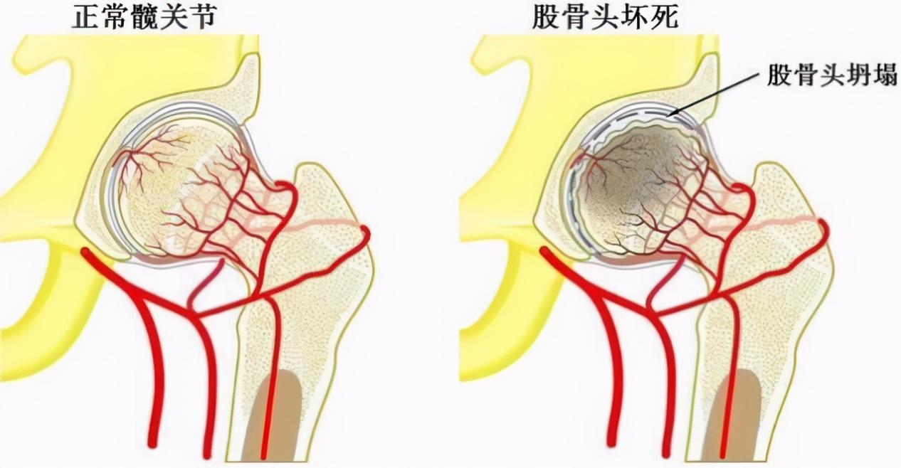 最新股骨头坏死治疗方法及其观点论述