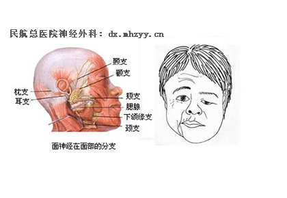 面肌痉挛最新最好治疗方法中医,面肌痉挛最新最好治疗方法中医