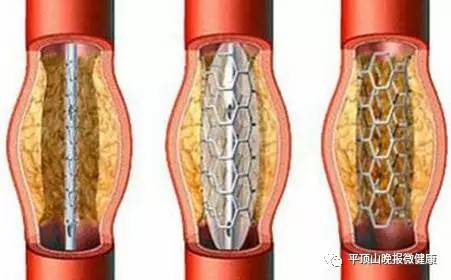 国产心脏支架价格深度解析与科普指南